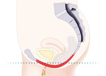 Pelvic-Floor Muscle Repair 5 Pelvic floor muscles Aldridge
