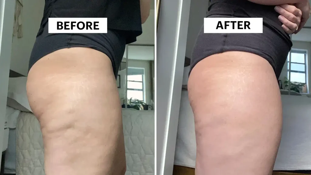 Do Toning Exercise Aldridge Really Tackle Cellulite?