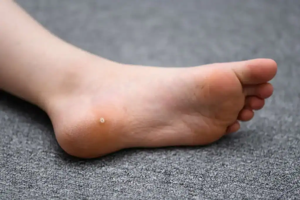 Cryotherapy For Warts And Also Verrucas 2 Image of verruca on the bottom of the foot that able to be treated with Cryotherapy Aldridge