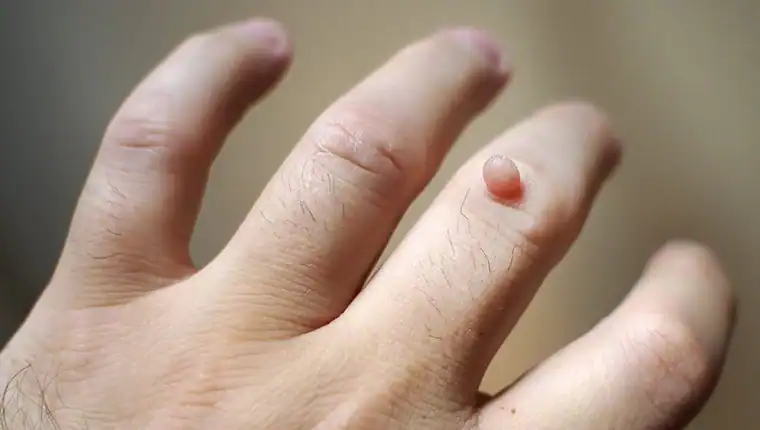 Image of blemish that Cryotherapy Aldridge can remove with Lipo 360.