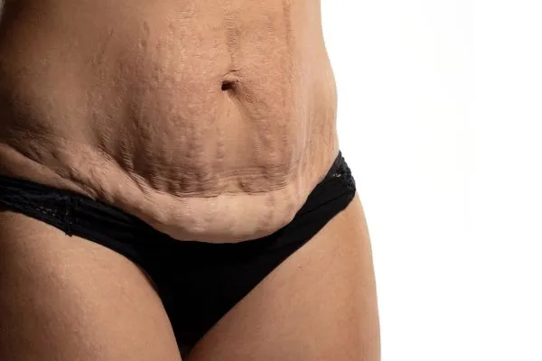 The Science of Skin Tightening 1 The science behind skin tightening Aldridge picture of a woman's sagging skin on the stomach